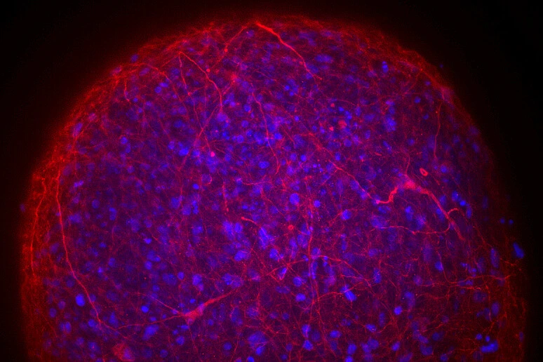 Sclerosi multipla, una molecola aiuta a riparare il sistema nervoso
